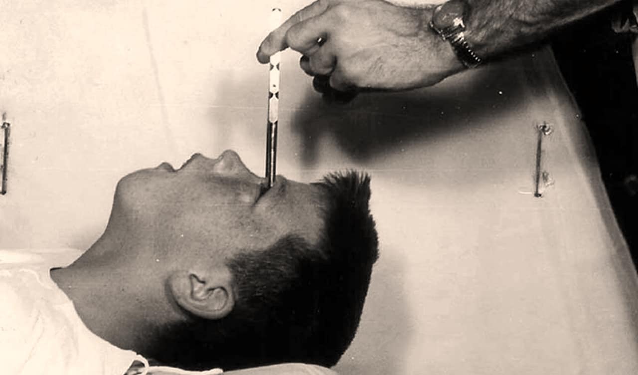 Horrifying Before And After Stories Of Lobotomy Victims 