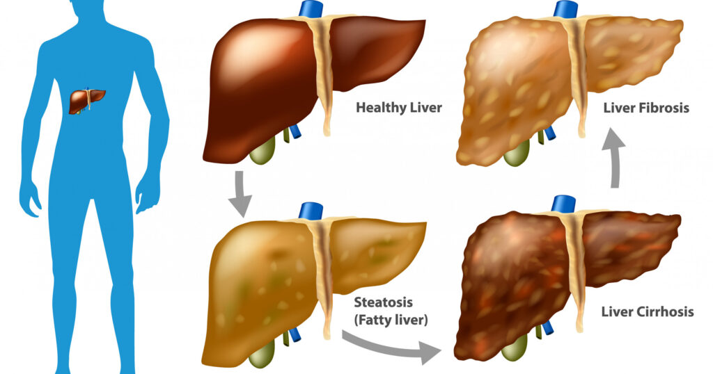 25 Revolutionary Liver Treatments Saving Lives Right Now