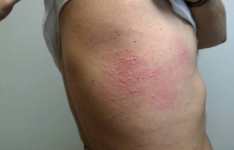 Shocking Discovery: Multiple Tick Species Can Trigger Deadly Red Meat Allergy — 25 Critical Facts That Could Save Your Life