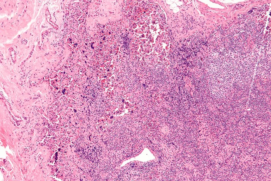 Northwestern Scientists Find the &#8216;Off Switch&#8217; for Lupus Hidden in Human DNA