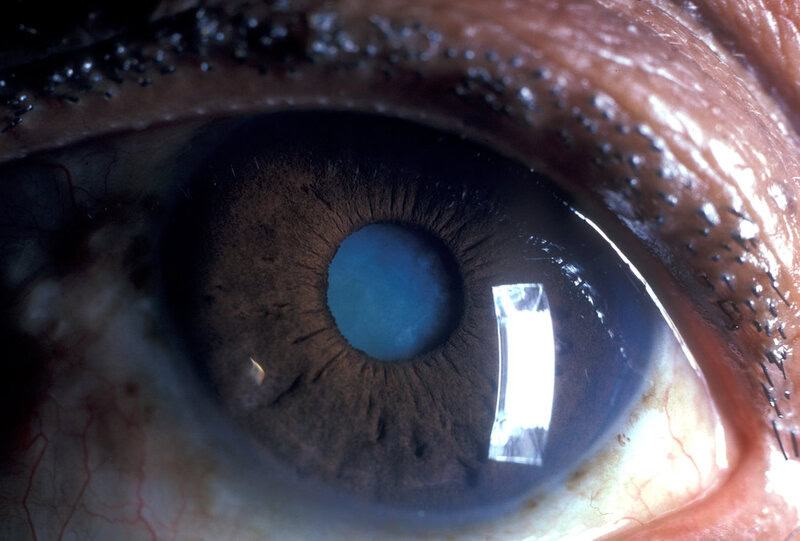 How Blue Light From Screens Affects Aging Eyes Differently Than Young Ones
