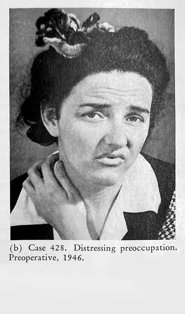 15 Disturbing Facts About the Lobotomy Doctor, Walter Freeman