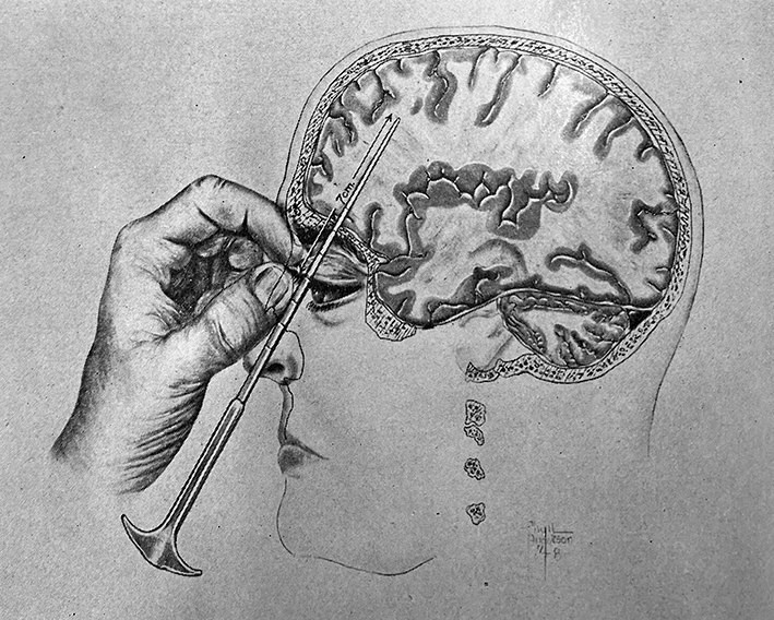 15 Disturbing Facts About the Lobotomy Doctor, Walter Freeman