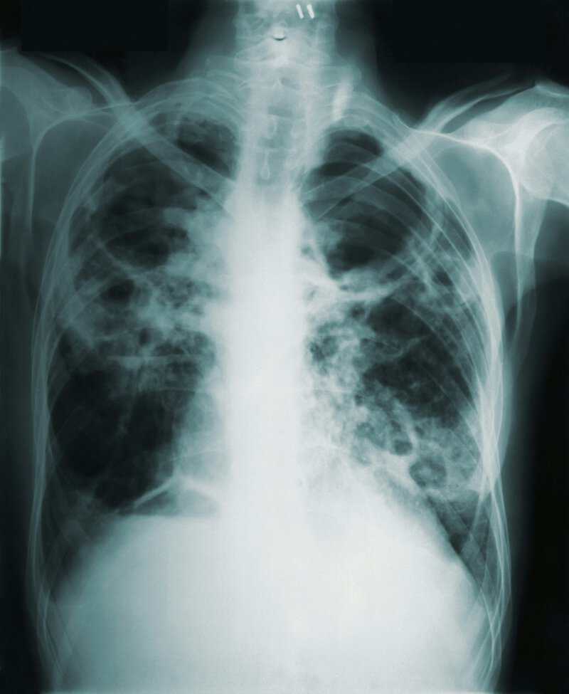 Tuberculosis Can Spread Before Symptoms Appear, Study Warns