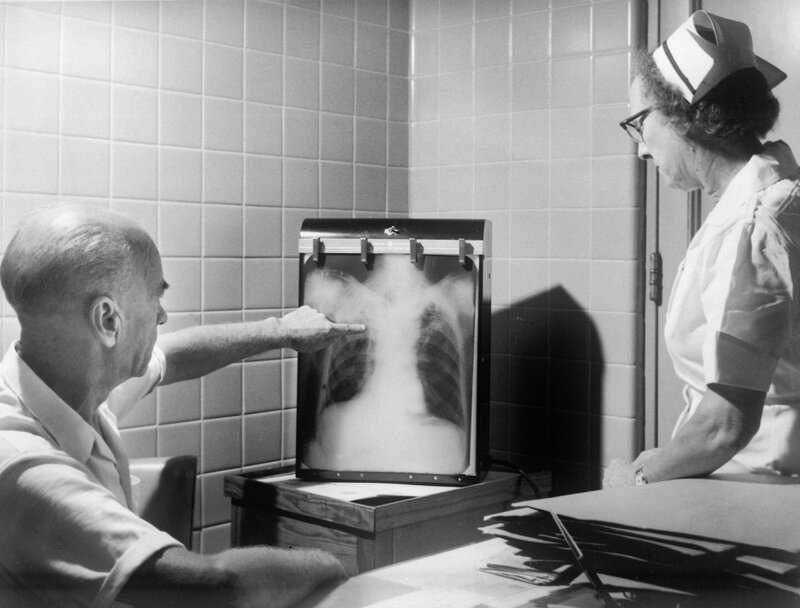 Tuberculosis Can Spread Before Symptoms Appear, Study Warns