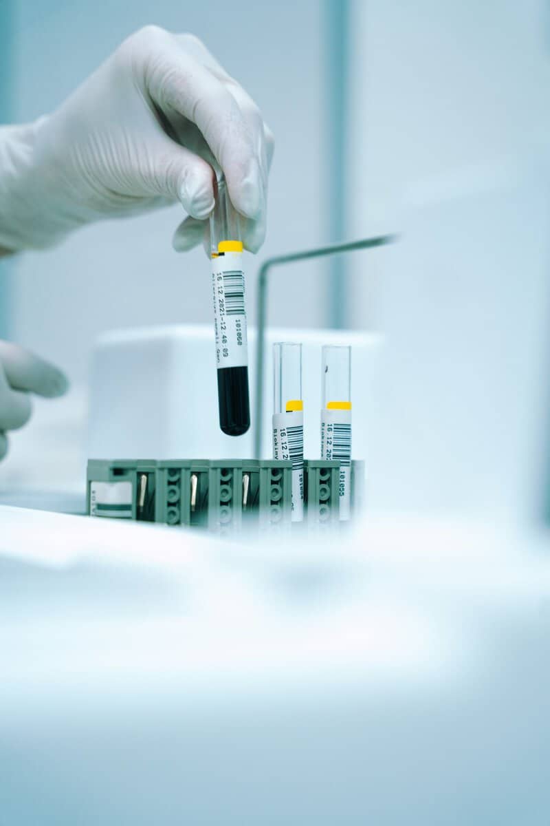 Aldosterone Drives CKD Progression Beyond Blood Pressure