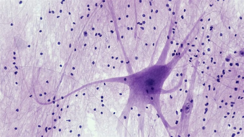 Alzheimer’s Brain Cell Death: Scientists Identify the Mechanisms Behind It