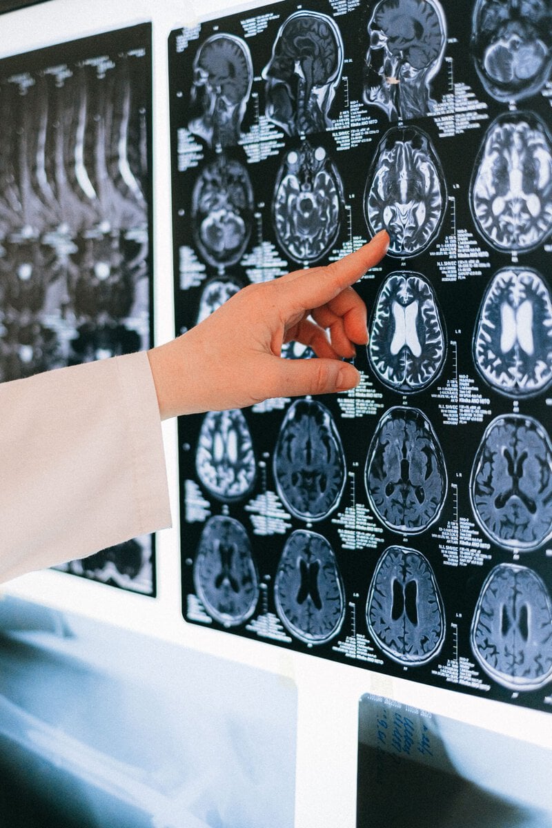 Stanford Found 6 Brain Subtypes of Depression—So Why Are Doctors Still Guessing?