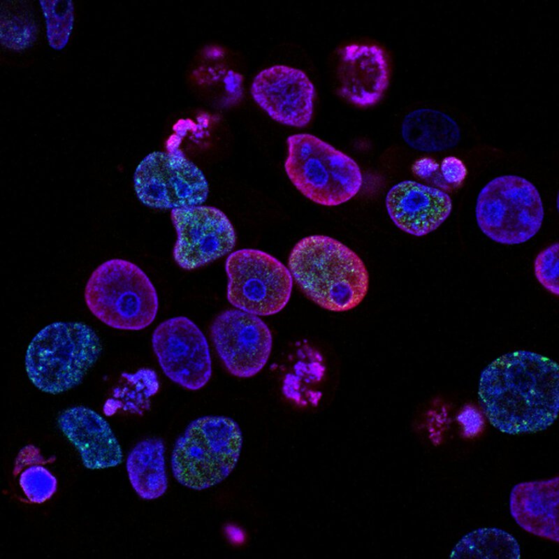 Why Psoriasis Biologics Fail 1 in 3 Patients — and What Genetics Reveal