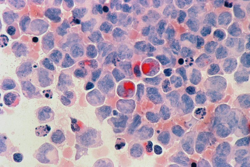 BTK Inhibitor Resistance: How Blood Cancers Bypass Even Next-Gen Drugs